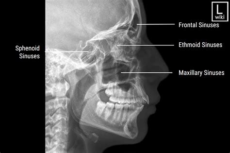 Xray Examination of the Nasal Bone .